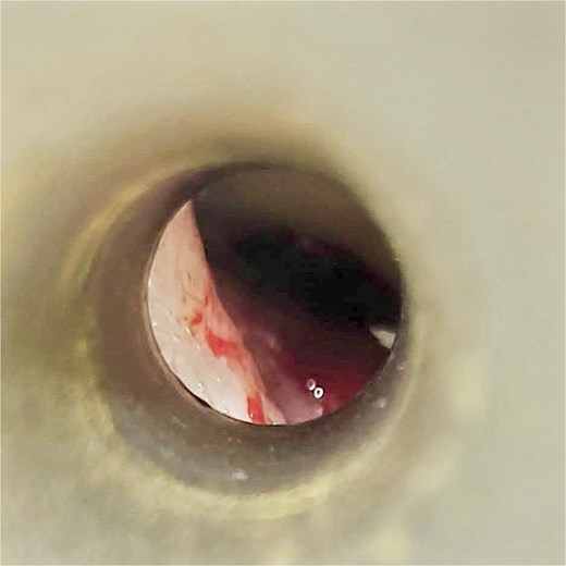 Otolaryngologic image of the left ear showing tympanic membrane injury with fresh blood in the external auditory canal.