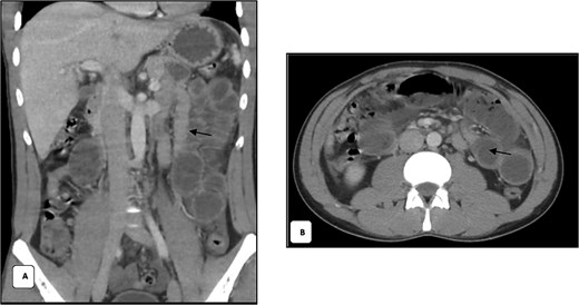 Contrast-enhanced CT images of the abdomen demonstrating small-bowel obstruction. Coronal and axial views show multiple dilated proximal jejunal and small-bowel loops with air-fluid levels and a distinct transition point in the left lower quadrant indicated by black arrows. Bowel wall enhancement and mesenteric vessel patency are preserved without signs of ischemia.