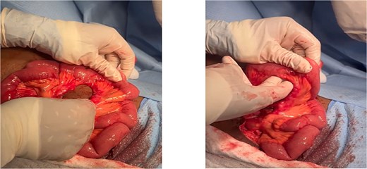 Intraoperative photographs demonstrating a handlebar-related mesenteric root injury. Panel (A) shows a mesenteric root defect identified during surgical exploration. Panel (B) shows the size of the defect, measuring approximately 4 times 5 cm (about 1.97 inches), with two fingers used for visual scale reference.