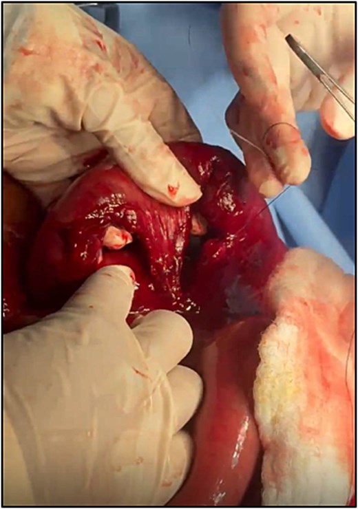 Intraoperative image showing an ischemic segment of small bowel that had internally herniated through mesenteric defects. The affected bowel appears compromised in viability and is associated with two completely avulsed defects within the mesentery.