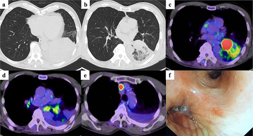 Imaging and bronchoscopic findings before diagnosis. Chest computed tomography showing (a) a mass lesion and (b) an infiltrative shadow in the left lower lobe of the lung. 18F-fluoro-2-deoxy-glucose (FDG) positron emission tomography demonstrating high FDG uptake in (c) the pulmonary lesion, (d) the left hilar lymph node, and (e) the right mediastinal lymph node. (f) Bronchoscopy revealing obstruction of the bronchus of the left lower lobe.