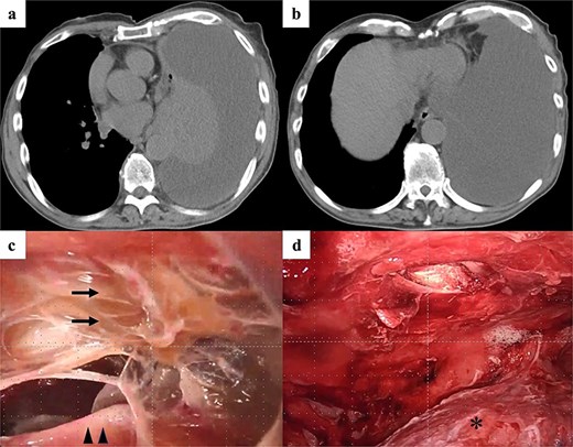 Intraoperative findings and surgical procedure. (a and b) Chest computed tomography showing an increase in the left pleural effusion. (c) Intraoperative findings showing fibrin precipitation (arrows) around the left lung (arrowheads). (d) Decortication around the left lung (asterisk) successfully performed by video-assisted thoracic surgery.