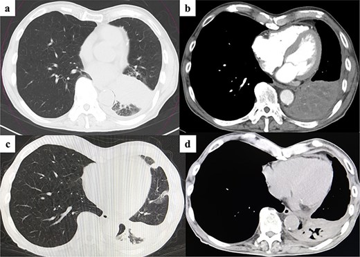 Postoperative imaging and treatment outcome. (a and b) Chest computed tomography showing no recurrence of empyema 1.5 months after surgery. (c and d) At 4 months after surgery, chest CT demonstrating no recurrence of empyema and reduction of the left lower lobe lesion following chemoradiotherapy and subsequent maintenance therapy with an immune checkpoint inhibitor.