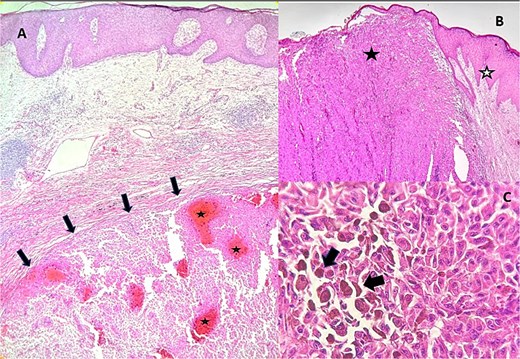Biopsy of dorsolumbar lesion. (A) Histologic section at 10× magnification showing a nodular dermal neoplasm (black arrows) composed of atypical melanocytes arranged in sheets, with areas of hemorrhage (white stars). (B) Histologic section at 10× magnification showing a dermal neoplasm (black star) that pushes the epidermis (white star), composed of atypical melanocytes arranged in sheets. (C) Histologic section at 40× magnification showing atypical, pleomorphic melanocytes with hyperchromatic nuclei (black arrows), prominent nucleoli, and intensely eosinophilic cytoplasm containing irregular melanin pigment.