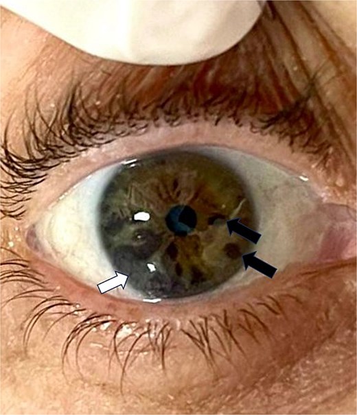 Iris metastatic melanoma lesion. Black-colored raised lesion located at the mid-inferior quadrant of the iris (white arrow), along with pigmented iris nevus (black arrows).