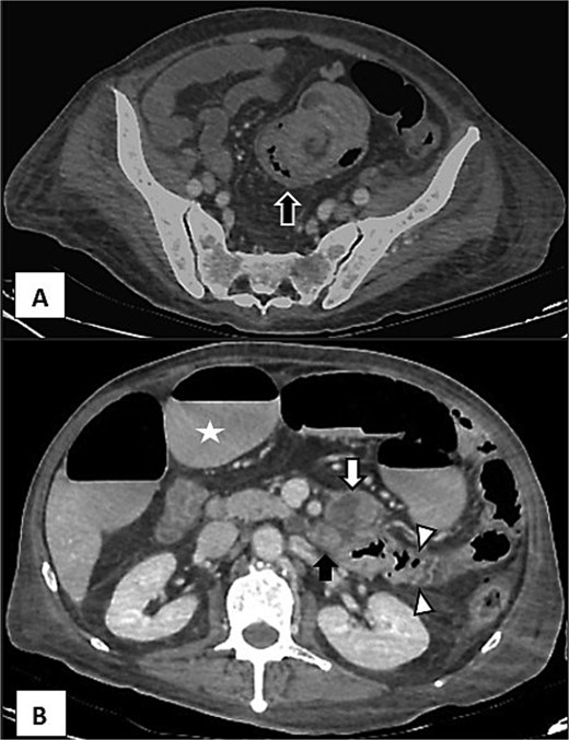 CT with venous phase showing intussusception and tumoral activity. (A) Intestinal intussusception showing “target sign” (black arrow) with wall oedema. (B) Upper view with distention of intestinal loops (white star) and tumoral activity adjacent to the third portion of duodenum (white arrow heads) associated to enlarged nodules (black arrow).