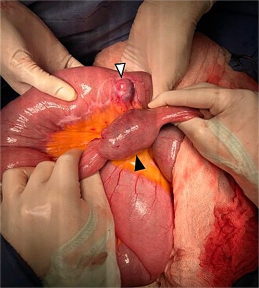 Surgical view showing two tumoral lesions depending from jejunum (white and black arrows). The largest lesion (black arrow) showing the site of intussusception.