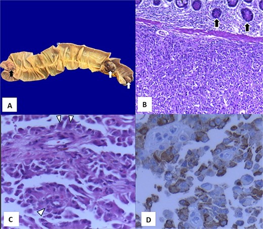 Histopathological analysis of the jejunal resected segment. (A) Macroscopic photograph of a small intestine segment showing an ulcerated lesion (black arrow) and two pedunculated nodular lesions (white arrows). (B) Panoramic photomicrograph (4x) stained with hematoxylin and eosin demonstrating replacement of the submucosa by a neoplasm composed of atypical epithelioid cells forming pseudorosettes (black arrows). (C) Photomicrograph at 40x magnification showing atypical epithelioid cells arranged around a fibrovascular core (white arrow heads). (D) Immunohistochemistry for Melan-a showing positive staining (brown color).