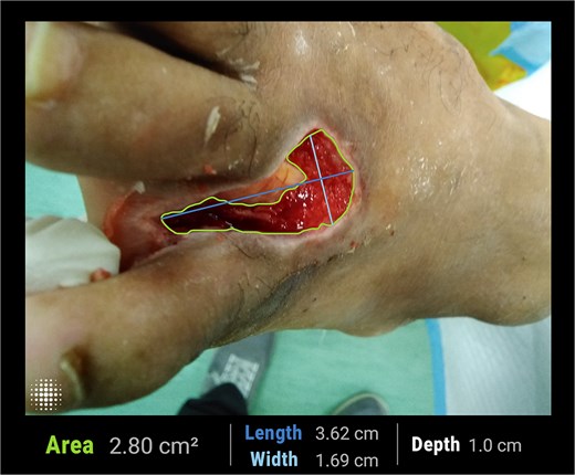 Clinical photograph of a chronic diabetic foot ulcer involving the fourth web space of the left foot at initiation of adjunctive laser therapy, demonstrating a deep ulcer with an exposed extensor digitorum longus tendon and a measured surface area of 2.8 cm2.