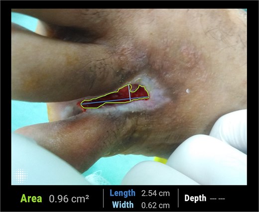 Clinical photograph after 3 weeks of adjunctive laser therapy, showing a reduction in ulcer surface area to 0.96 cm2 with early granulation tissue formation beginning to extend over the previously exposed tendon.