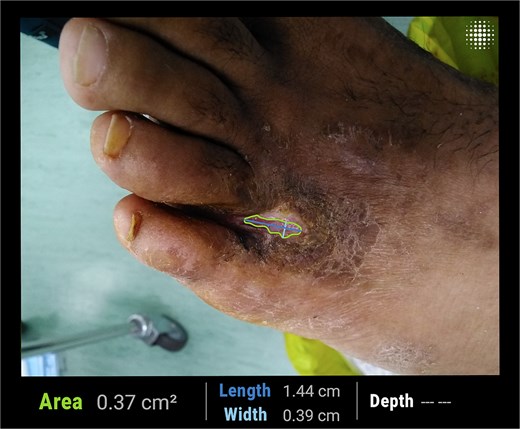 Clinical photograph after 6 weeks of adjunctive laser therapy, demonstrating further reduction in ulcer surface area to 0.37 cm2, complete coverage of the extensor tendon by granulation tissue, and a healthy wound bed.