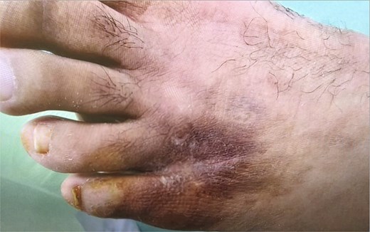 Clinical photograph at 8-week follow-up following initiation of adjunctive laser therapy, demonstrating complete epithelialization of the ulcer with no residual open wound.