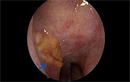Transnasal Endoscopic view of Nasopharyngeal Amyloidoma involving the right lateral wall of nasopharynx