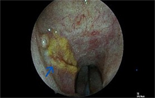 Transnasal Endoscopic view of Nasopharyngeal Amyloidoma involving the right lateral wall of nasopharynx(Spectra B -narrow band image)