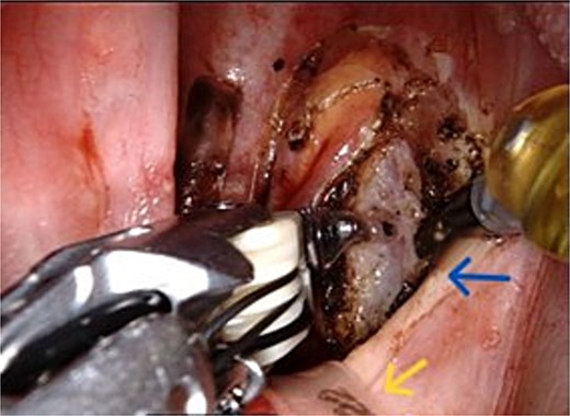 Transoral robotic resection(TORS) image, yellow pointer showing the suction catheter used to retract the soft palate and the blue pointer points towards the retracted soft palate and the retropalatal amyloidoma involving the right lateral wall of nasopharynx