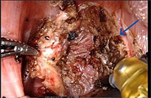 Transoral robotic resection (TORS)image of the nasopharyngeal amyloidoma showing the amyloidoma being dissected off the superior constrictor muscle underneath.