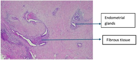 Low-power histopathology image (4 times magnification) showing endometrial glands and surrounding endometrial stroma embedded within fibroconnective tissue, consistent with abdominal wall endometriosis.