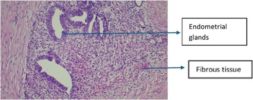 High-power histopathology image (20 times magnification) demonstrating endometrial glands lined by epithelial cells with surrounding endometrial stroma within fibroconnective tissue, confirming abdominal wall endometriosis.