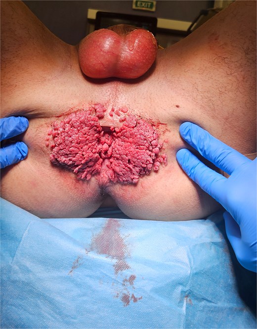 View of a perianal region with a large, cauliflower-like tumor surrounding the anus in Case 1.