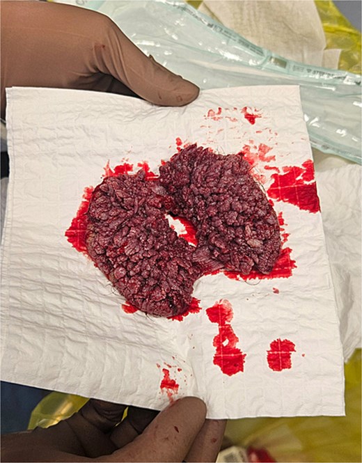 The removed tumor specimen in Case 1.