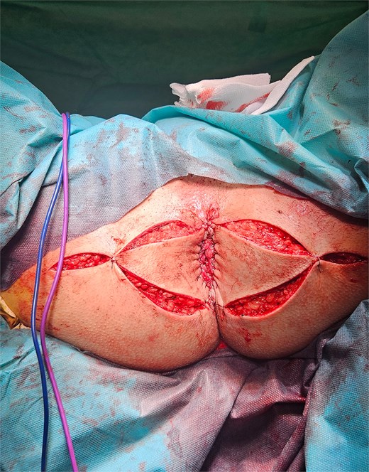 Completed V-Y flap reconstruction covering the defect.