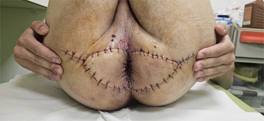 Surgical flaps five days after operation.