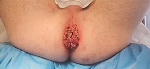 Large, wart-like tumor at the anal margin in Case 2.