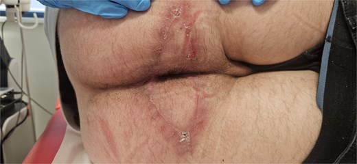 Late postoperative follow-up in Case 2.