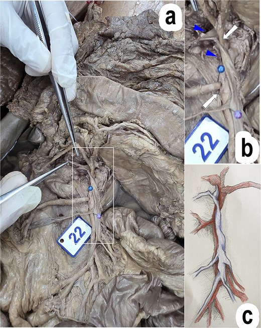 Three-panel figure showing an anatomical variation of the superior mesenteric vessels in a cadaveric specimen. Panel (a): intraoperative cadaveric photograph showing the superior mesenteric vein (SMV) crossing anteriorly over the superior mesenteric artery (SMA) and assuming a left-sided position at the level of the third part of the duodenum (D3), with arrows indicating the SMA and arrowheads indicating the SMV. Panel (b): magnified cadaveric photograph of the same region showing the spatial relationship between the SMV and SMA in greater detail. Panel (c): schematic illustration depicting the anomalous posterior-to-left course of the SMV relative to the SMA, from the pancreatic head level to D3.
