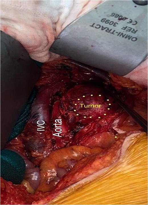 Retroperitoneal tumor adjacent to the aorta and inferior vena cava.