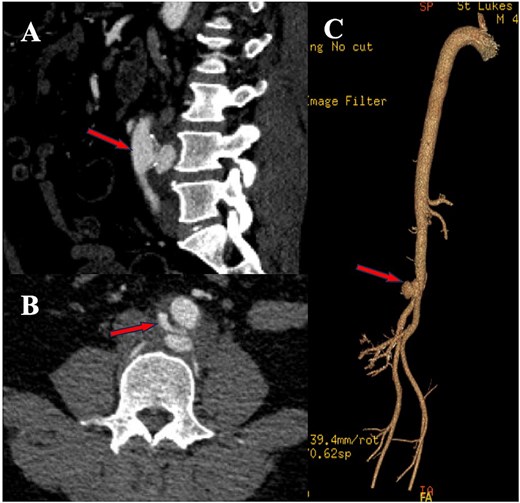 Images from CTA with subfigures A-C showing the pseudoaneurysm in various views.