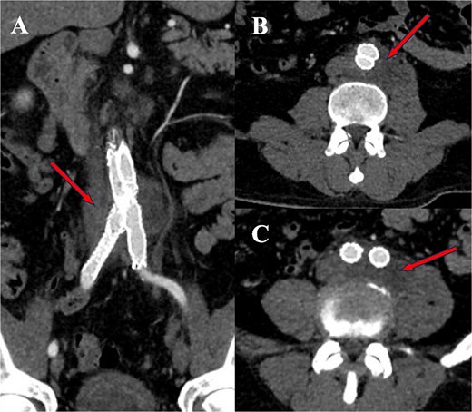 Images from CTA showing the mycotic aneurysm and associated infected collection in various planes via subfigures A-C.