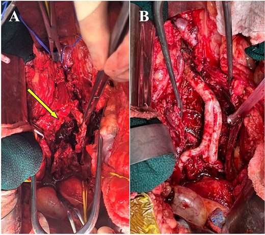 Photos showing the operative field at two stages, indicated by subfigures A and B.