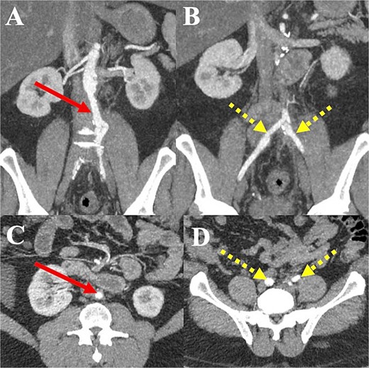 Images from interval postoperative CTA with subfigures A-D showing the patent graft in various planes.