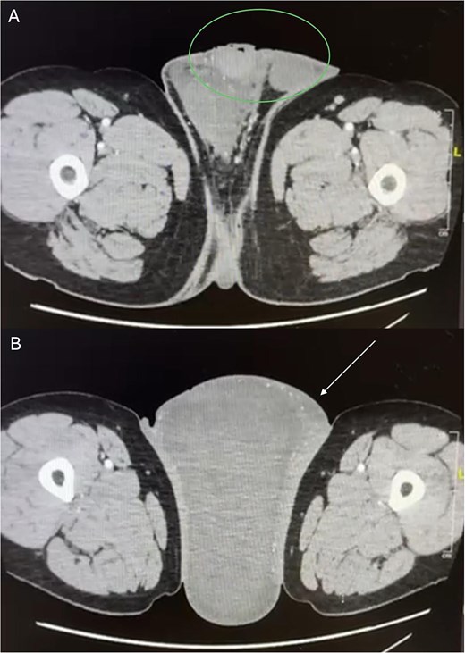 Axial computed tomography (CT) images of the scrotum. (A) Demonstrating a large heterogeneous soft-tissue mass occupying the scrotal sac. The right testis (green circle) is displaced cranially into the inguinal canal by the mass effect. (B) Showing the bulky scrotal mass with marked thickening of the scrotal cutaneous and subcutaneous tissues and multiple small vascular structures suggestive of neoangiogenesis (white arrow).