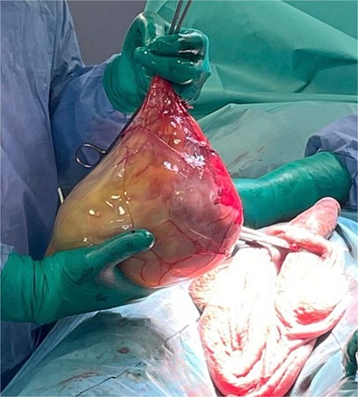 Intraoperative image demonstrating a large, wellencapsulated paratesticular mass following surgical excision. The mass appears smooth and tense with prominent superficial vascularity, consistent with its benign nature.