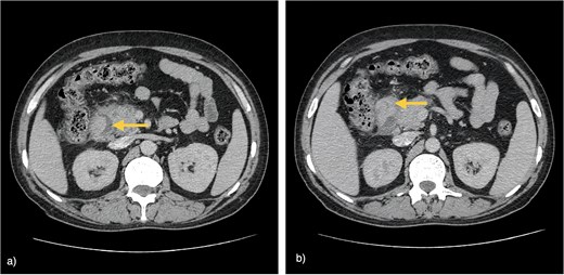 Two axial contrast-enhanced CT images of the upper abdomen. Panel (a) displays a focal area of hypodensity in the pancreaticoduodenal groove with a yellow arrow. Adjoining pancreatic head is enlarged. Panel (b) highlights luminal narrowing in duodenum with thickened wall at the D1-D2 level marked by a yellow arrow. It shows heterogeneous enhancement and adjacent fat stranding.