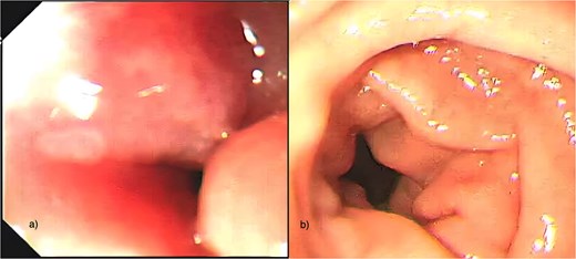 Side-by-side endoscopic photographs of the duodenum. Panel (a) reveals severe narrowing at the D1-D2 junction with protruding, erythematous mucosa and near-total obstruction. Panel (b) shows the same region after treatment with a widely patent lumen and markedly smoother mucosal surface.