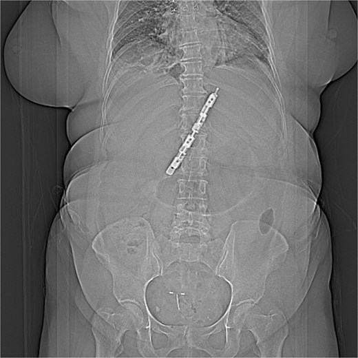 CT image of the upper abdomen demonstrating a hyperdense linear BariClip in the mid-upper abdomen.