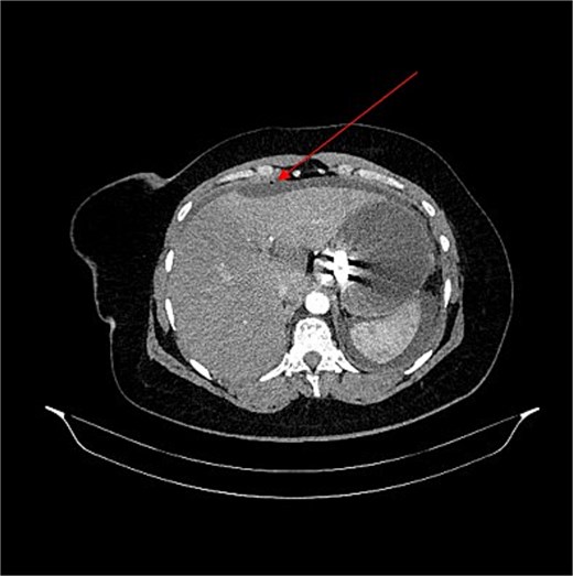 Axial arterial phase CT image showing the gastric clip along the lesser curvature of the stomach with gastric distension, abdominal ascites, and focal pneumoperitoneum indicated by a red arrow.