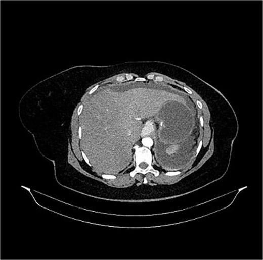 CT image of the abdomen demonstrating multiple focio f pneumoperitoneum within the abdominal cavity consistent with visceral perforation.