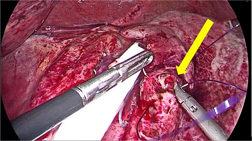 Intraoperative photograph demonstrating slipped gastric clip with gastric wall perforation repaired using primary suturing, indicated by a yellow arrow.