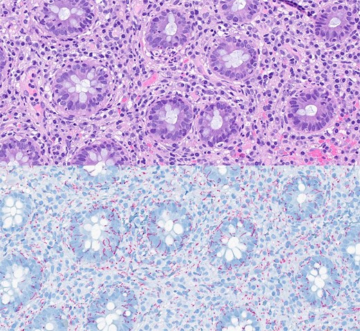 Histopathological features of the biopsy specimen from rectal syphilis showing a well-preserved epithelium with some inflammation and no dysplasia (top picture); in the lamina propria, there is a diffuse lymphoplasmacytic infiltrate (haematoxylin and eosin stain x 4000); immunohistochemical staining for Treponema pallidum (bottom) verifies a large number of spirochetes (x 4000).