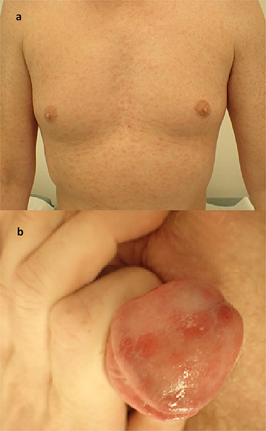 Photos taken at the outpatient clinic for dermatology and venereal disease showing a non-itchy, generalized red maculopapular rash of the chest and arms (Top); the same rash affected several parts of the body; in addition, the patient had penile sores, which were not the primary chancre or site of inoculation, but rather a cutaneous presentation of the systemic affliction of the secondary stage of the disease (Bottom).