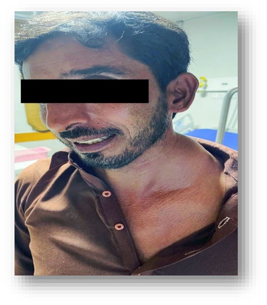 Clinical photograph of a patient's left cervical region demonstrating a conspicuous, solitary, ovoid mass located in the inferolateral aspect and extending into the supraclavicular fossa and lower cervical triangle. The overlying skin appears normal with no discoloration, ulceration, or other cutaneous stigmata.