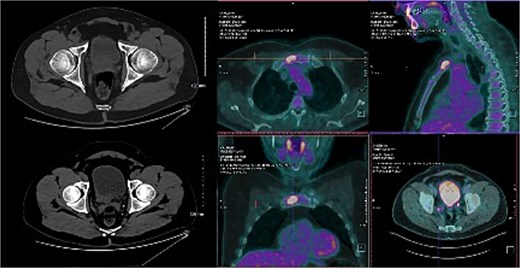 Baseline CT and FDG PET/CT images showing a bladder tumor with increased metabolic activity, pelvic lymph node involvement in the right internal iliac region, and a hypermetabolic bone metastasis in the manubrium.