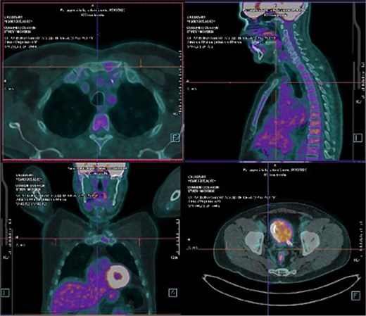 Follow-up FDG PET/CT images after 3 months of enfortumab vedotin plus pembrolizumab (EVP) showing complete metabolic response, with disappearance of previously hypermetabolic bladder, lymph node, and bone lesions. The manubrial lesion evolved into a non-hypermetabolic sclerotic bone lesion.
