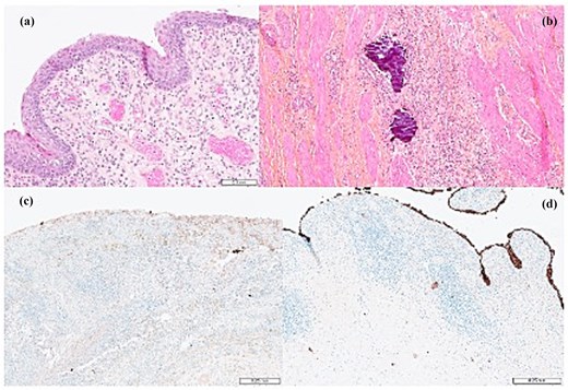 Histopathological and immunohistochemical images of the radical cystoprostatectomy specimen showing complete pathological response without residual viable tumor cells. Microscopy demonstrates regenerative urothelial mucosa, granulation tissue, inflammatory infiltrates, and dystrophic calcifications consistent with treatment-related changes. Pancytokeratin AE1/AE3 immunostaining confirms the absence of residual carcinoma cells, with preserved staining limited to normal superficial urothelial cells.