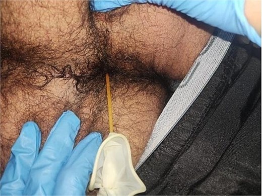 CT revealing a ventriculoperitoneal shunt (VPS) catheter protruding from the anal orifice. A clinician's hand in a blue nitrile glove with its distal tip placed inside a beige examination glove.