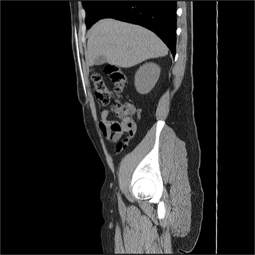 A sagittal CT scan section of the abdominal and pelvic region. A high-density, white linear structure representing a catheter is visible tracking through the intraparietal space of the anterior abdominal wall. The scan shows the catheter's before entering the abdominal cavity.